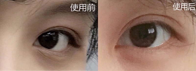 不会分泌油脂,过度厚重的眼霜容易堵塞眼部细小毛孔而长出脂肪粒